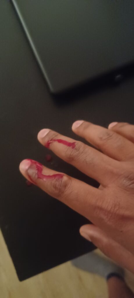 Hamster bit me and drew blood